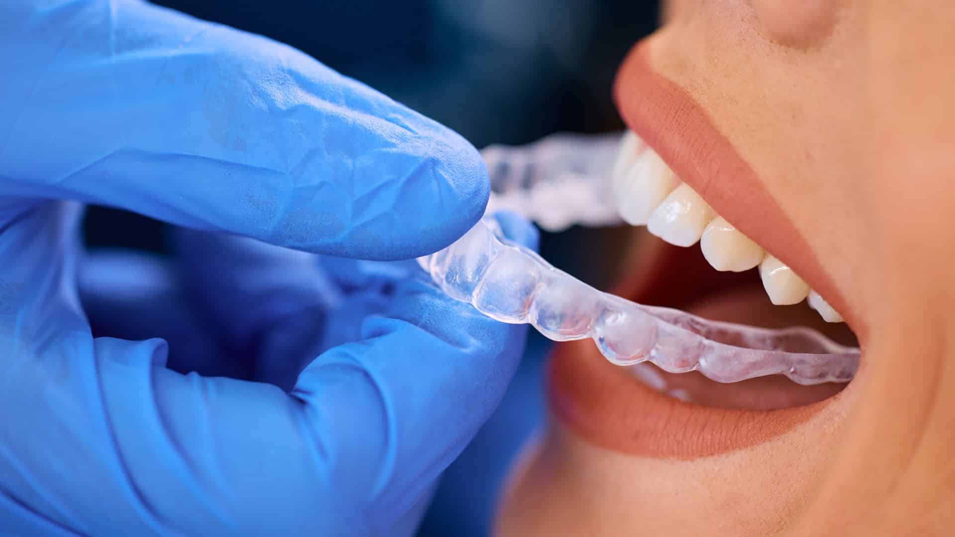 How Invisalign Aligner Changes Affect Your Dietary Habits and Nutritional Timing Throughout Treatment